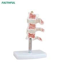 XC-134 هشاشة العظام